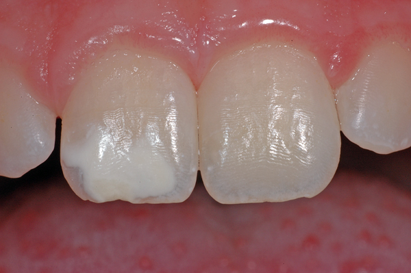 Weisser Fleck auf dem rechten oberen Schneidezahn (Zahn 11) einer 7-jährigen Patientin