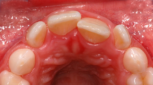 Ursache: zu weit palatinal stehender Zahn