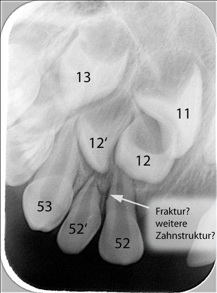 Röntgenbild 2 der Oberkiefer-Front mit Zahnbezeichnungen und Informationen