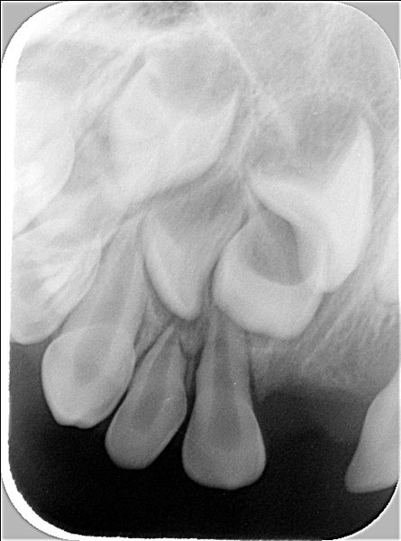 Röntgenbild 2 der Oberkiefer-Front (mehr seitlich von rechts aufgenommen, um den überzähligen Zahn 12' darzustellen)