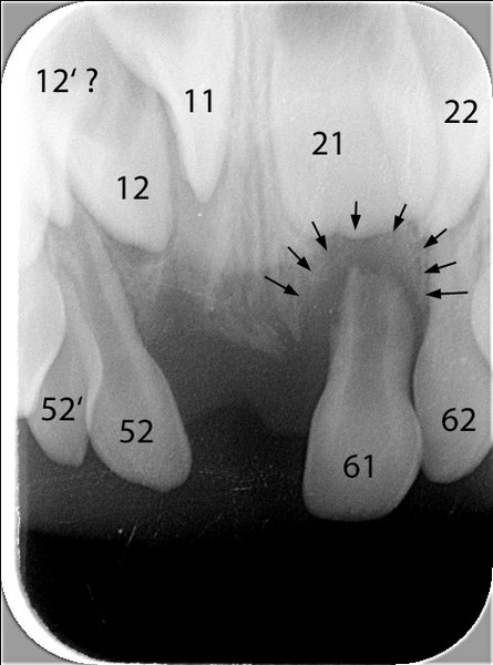 Röntgenbild der Oberkiefer-Front mit Zahnbezeichnungen und Informationen