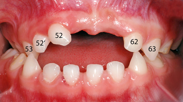 Ansicht von vorne, Zähne nummeriert