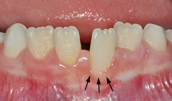 Detailansicht des 31 mit Rezession (schwarze Pfeile)