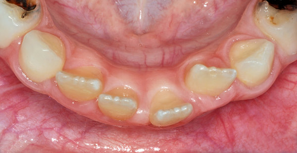 Ansicht Unterkiefer von inzisal, Zahn 31 steht weit labial (aussen, gegen die Lippe)