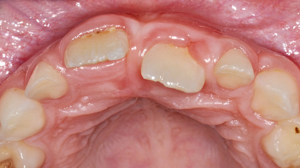 Ansicht Oberkiefer von inzisal, Zahn 21 steht weit palatinal (innen auf der Gaumenseite)