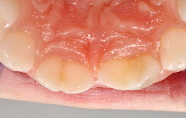 Zahnverschmelzung 51/52 und 61/62, Ansicht von palatinal (innen)