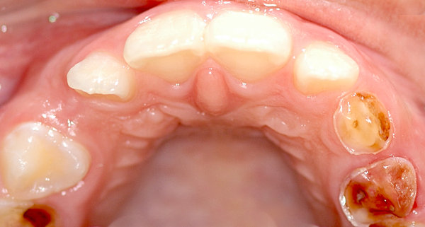 Beispiel eines etwas älteren Patienten (ca. 8 Jahre alt) mit vorzeitigem Verlust des Eckzahnes rechts (vom Patient aus gesehen, im Bild links) und zerstörtem Milcheckzahn links. Alle Scheidezähne sind schon bleibende Zähne. Ein leicher Platzverlust auf der rechten Seite ist wohl eingetreten.
