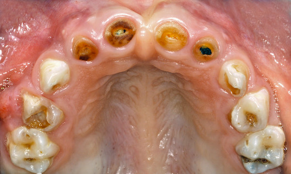 Karies an allen Zähnen im Oberkiefer, Frontzähne komplett zerstört, Eckzähne an Aussen- und Innenflächen betroffen