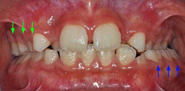 248884_04a.jpg (586.92 KiB) 9748 mal betrachtet Frontansicht, ganzes Gebiss