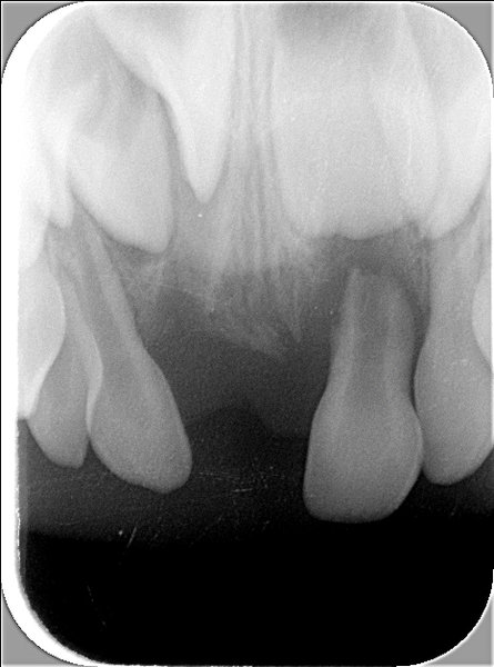 352349_04.jpg (172.91 KiB) 7644 mal betrachtet Röntgenbild der Oberkiefer-Front