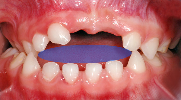 352349_03.jpg (738.11 KiB) 7644 mal betrachtet Offener Biss in der Front (blau markierte Zone)