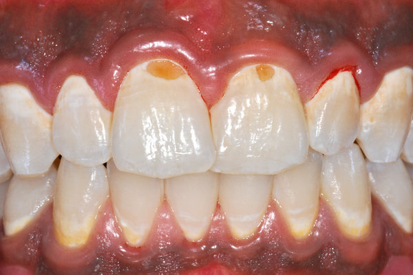 173787_01.jpg (729.58 KiB) 26606 mal betrachtet Frontansicht: 11 und 21 mit Karies, andere Frontzähne mit starken Entkalkungen