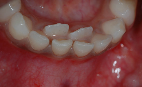Durchbruch bleibender mittlerer Frontzähne hinter den Milchzähnen