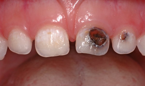 326593_01.jpg (607.28 KiB) 30154 mal betrachtet Karies an 61 und 62