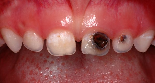 326593_02.jpg (588.81 KiB) 30185 mal betrachtet Karies an 61 und 62