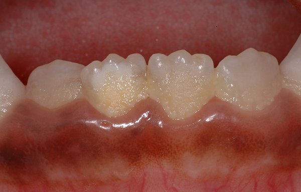 381421_01.jpg (319.89 KiB) 27171 mal betrachtet Weisser Fleck und Plaque